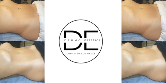 Extreme Revolution: perdi almeno 1 cm all’ora! Il trattamento corpo rivoluzionario arriva a Monza e Brianza
