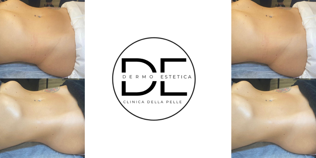 Pancia piatta per l’estate: perdi una taglia in 10 giorni con Clinica della Pelle - Dimensione Estetica a Monza e Brianza