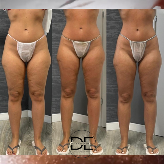 Extreme Body: Il Trattamento Avanzato per Rimodellare il Corpo da Dimensione Estetica